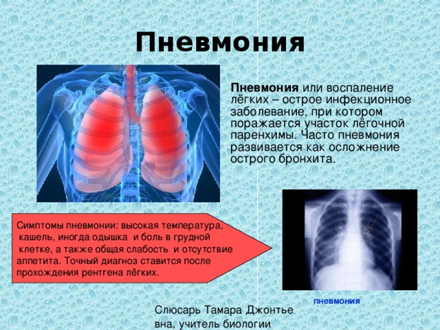 Пневмония  Пневмония или воспаление лёгких – острое инфекционное заболевание, при котором поражается участок лёгочной паренхимы. Часто пневмония развивается как осложнение острого бронхита. Симптомы пневмонии: высокая температура,  кашель, иногда одышка и боль в грудной  клетке, а также общая слабость и отсутствие аппетита. Точный диагноз ставится после прохождения рентгена лёгких. пневмония 