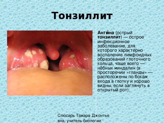 Тонзиллит Анги́на (острый тонзиллит ) — острое инфекционное заболевание, для которого характерно воспаление лимфоидных образований глоточного кольца, чаще всего — нёбных миндалин (в просторечии «гланды» — расположены по бокам входа в глотку и хорошо видны, если заглянуть в открытый рот). 