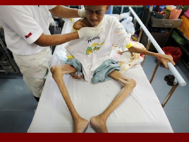 Стадии болезни СПИДа Заражение инфекцией ВИЧ : недельная лихорадка, увеличение лимфатических узлов, сыпь. Через месяц в крови обнаруживаются антитела к ВИЧ. Скрытый период : от нескольких недель до нескольких лет. Изъязвления слизистой, грибковые поражения кожи, похудание, диарея, повышенная температура тела. СПИД: воспаление легких, опухоли (саркома Капоши), сепсис и другие инфекционные заболевания.  