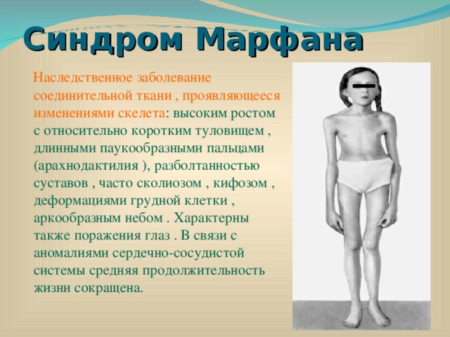 Синдром Марфана  Наследственное заболевание соединительной ткани , проявляющееся изменениями скелета : высоким ростом с относительно коротким туловищем , длинными паукообразными пальцами (арахнодактилия ), разболтанностью суставов , часто сколиозом , кифозом , деформациями грудной клетки , аркообразным небом . Характерны также поражения глаз . В связи с аномалиями сердечно-сосудистой системы средняя продолжительность жизни сокращена. 