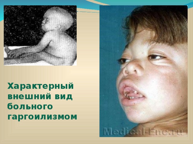 Характерный внешний вид больного гаргоилизмом 