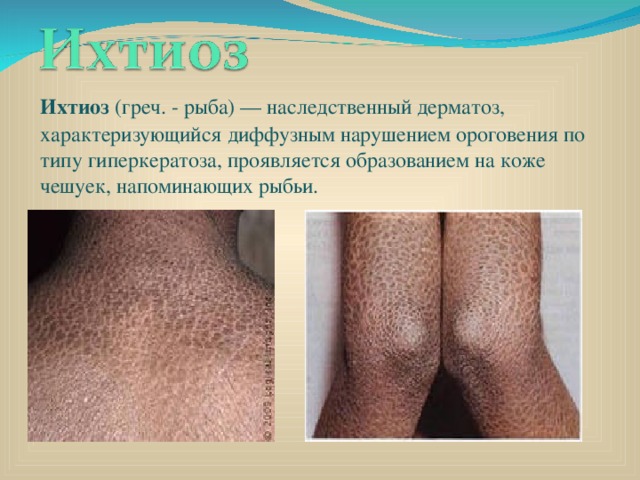 Ихтиоз (греч. - рыба) — наследственный дерматоз, характеризующийся диффузным нарушением ороговения по типу гиперкератоза, проявляется образованием на коже чешуек, напоминающих рыбьи. 