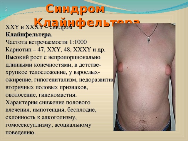  Синдром Клайнфельтера : ХХY и XXXY – синдром Клайнфельтера . Частота встречаемости 1:1000 Кариотип – 47, XXY, 48, XXXY и др. Высокий рост с непропорционально длинными конечностями, в детстве- хрупкое телосложение, у взрослых- ожирение, гипогенитализм, недоразвитие вторичных половых признаков, оволосение, гинекомастия. Характерны снижение полового влечения, импотенция, бесплодие, склонность к алкоголизму, гомосексуализму, асоциальному поведению. 