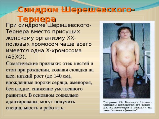 Синдром Шерешевского-Тернера При синдроме Шерешевского-Тернера вместо присущих женскому организму ХХ-половых хромосом чаще всего имеется одна Х-хромосома (45ХО). Соматические признаки: отек кистей и стоп при рождении, кожная складка на шее, низкий рост (до 140 см), врожденные пороки сердца, аменорея, бесплодие, снижение умственного развития. В основном социально адаптированы, могут получить специальность и работать. 