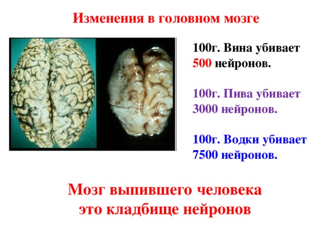 Изменения в головном мозге 100г. Вина убивает 500 нейронов.  100г. Пива убивает 3000 нейронов.  100г. Водки убивает 7500 нейронов. Мозг выпившего человека это кладбище нейронов 