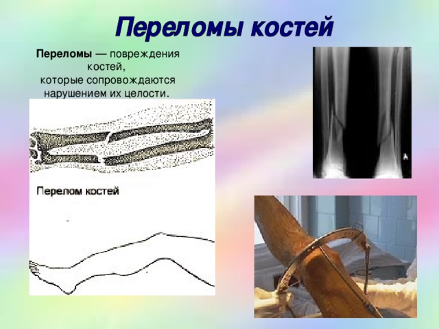 Переломы 