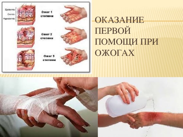 Оказание первой помощи при ожогах 